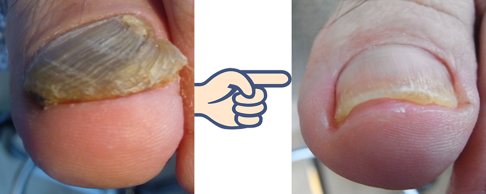鉤爪 爪甲鉤弯症 改善施術 新横浜 足と爪の痛みセンター 旧巻き爪救急センター